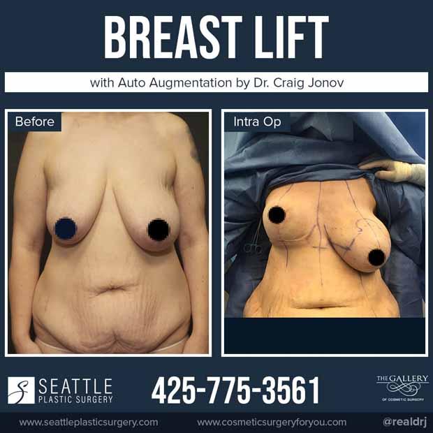A Before and Intra Op photo of a Breast Lift with Auto Augmentation Plastic Surgery by Dr. Craig Jonov
