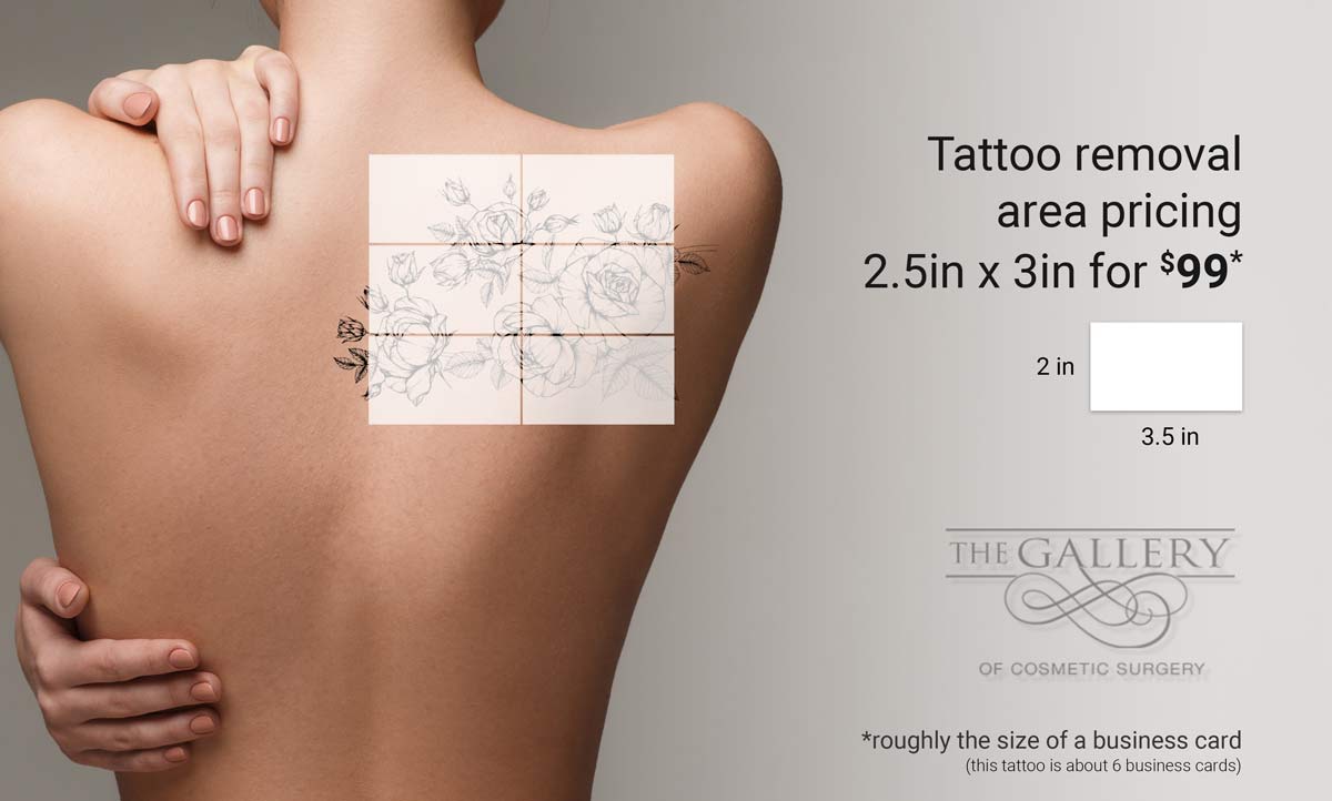 Image of Tattoo Removal pricing | The Gallery of Cosmetic Surgery