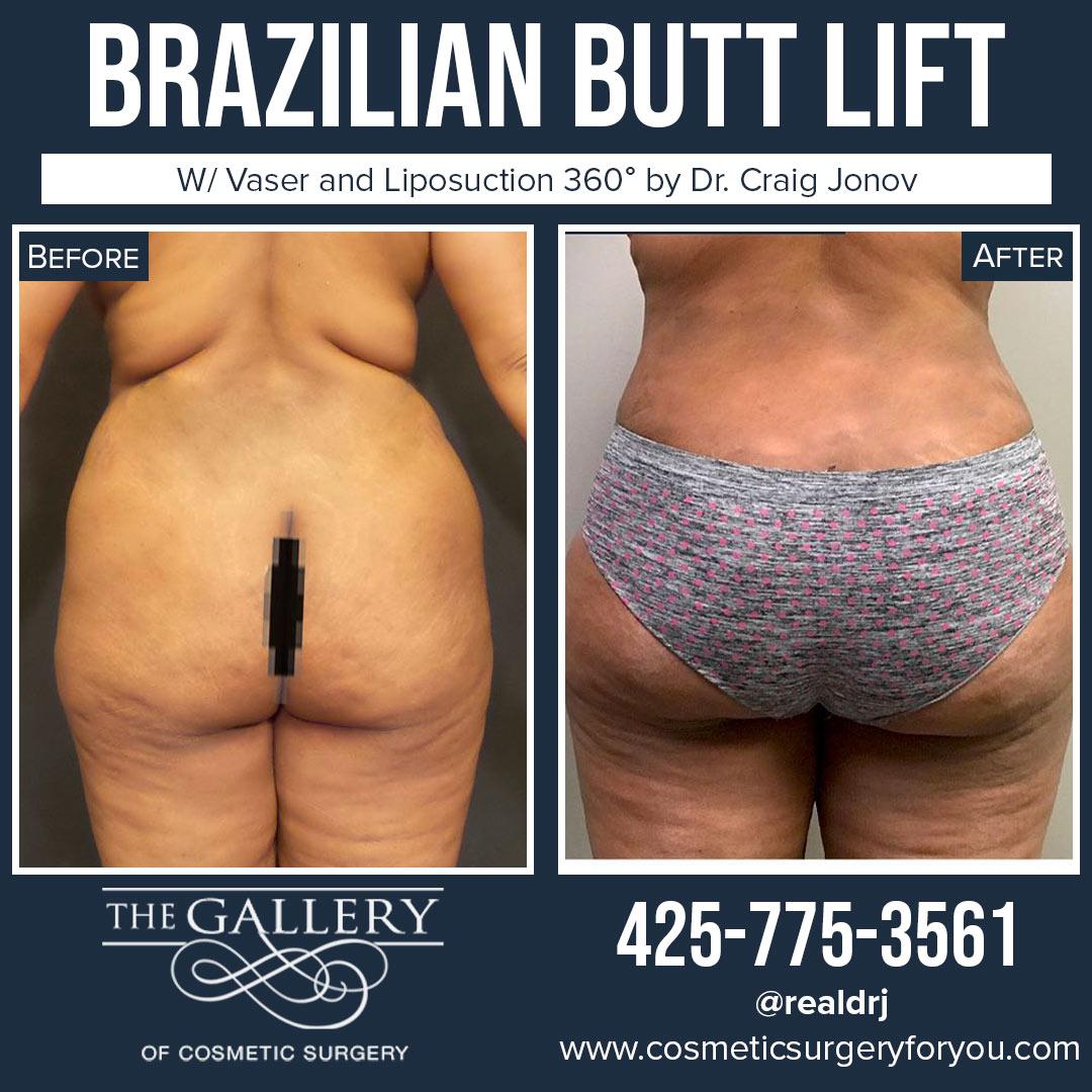 A Before and After photo of a Brazilian Butt Lift Plastic Surgery With Liposuction by Dr. Craig Jonov