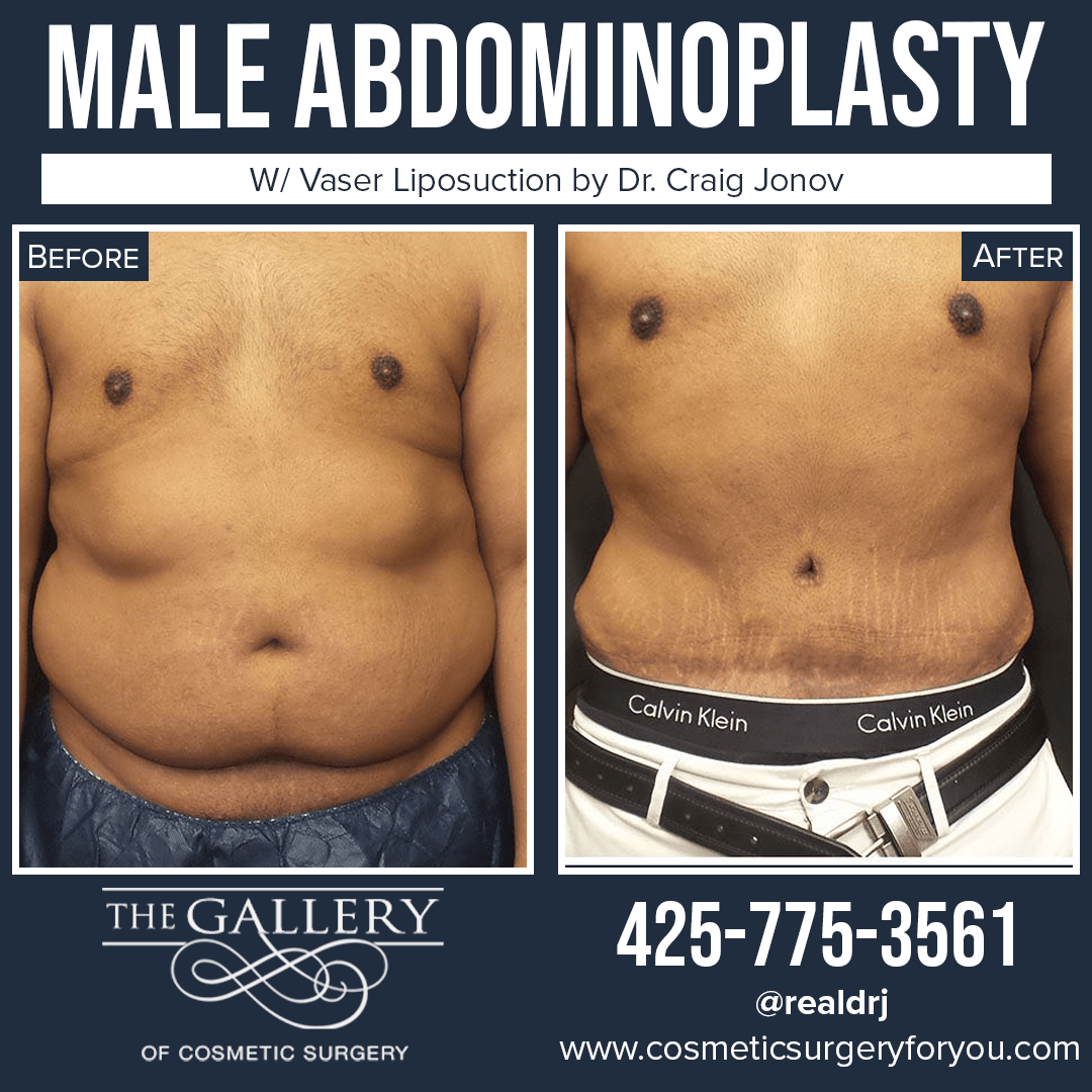 A Before and After Photo of a Male Abdominoplasty Surgery By Dr. Craig Jonov