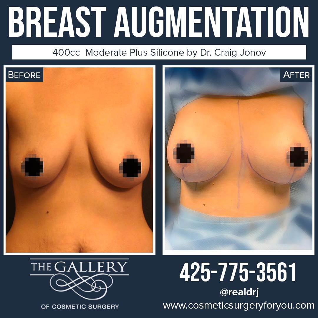 A Before and After photo of a Breast Augmentation Plastic Surgery by Dr. Craig Jonov
