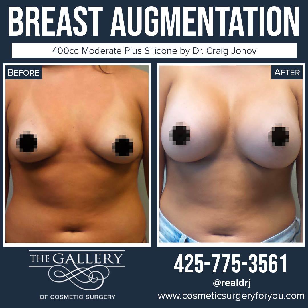 A Before and After photo of a Breast Augmentation Plastic Surgery by Dr. Craig Jonov