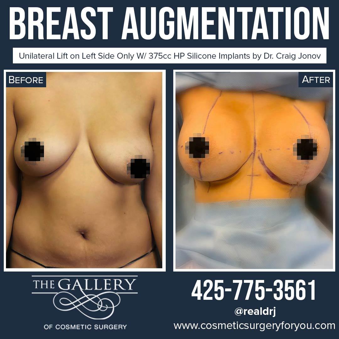 A Before and After photo of a Breast Augmentation Plastic Surgery by Dr. Craig Jonov