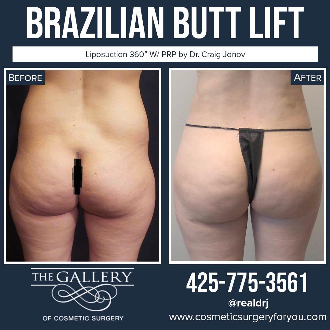 A Before and After photo of a Brazilian Butt Lift Plastic Surgery With Liposuction by Dr. Craig Jonov