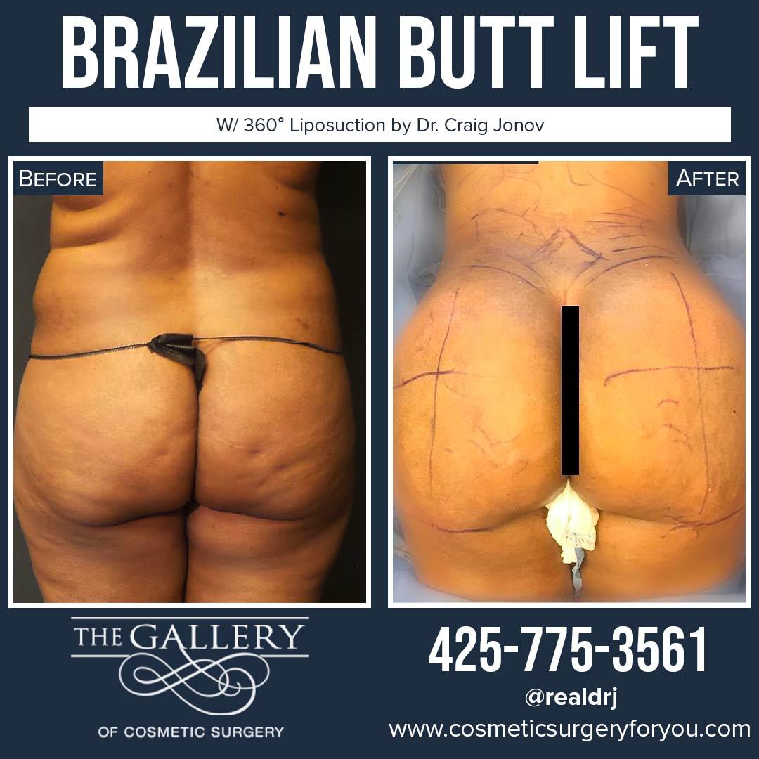 A Before and After photo of a Brazilian Butt Lift Plastic Surgery With Liposuction by Dr. Craig Jonov