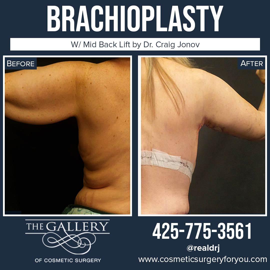 A Before and After photo of a Brachioplasty Plastic Surgery by Dr. Craig Jonov