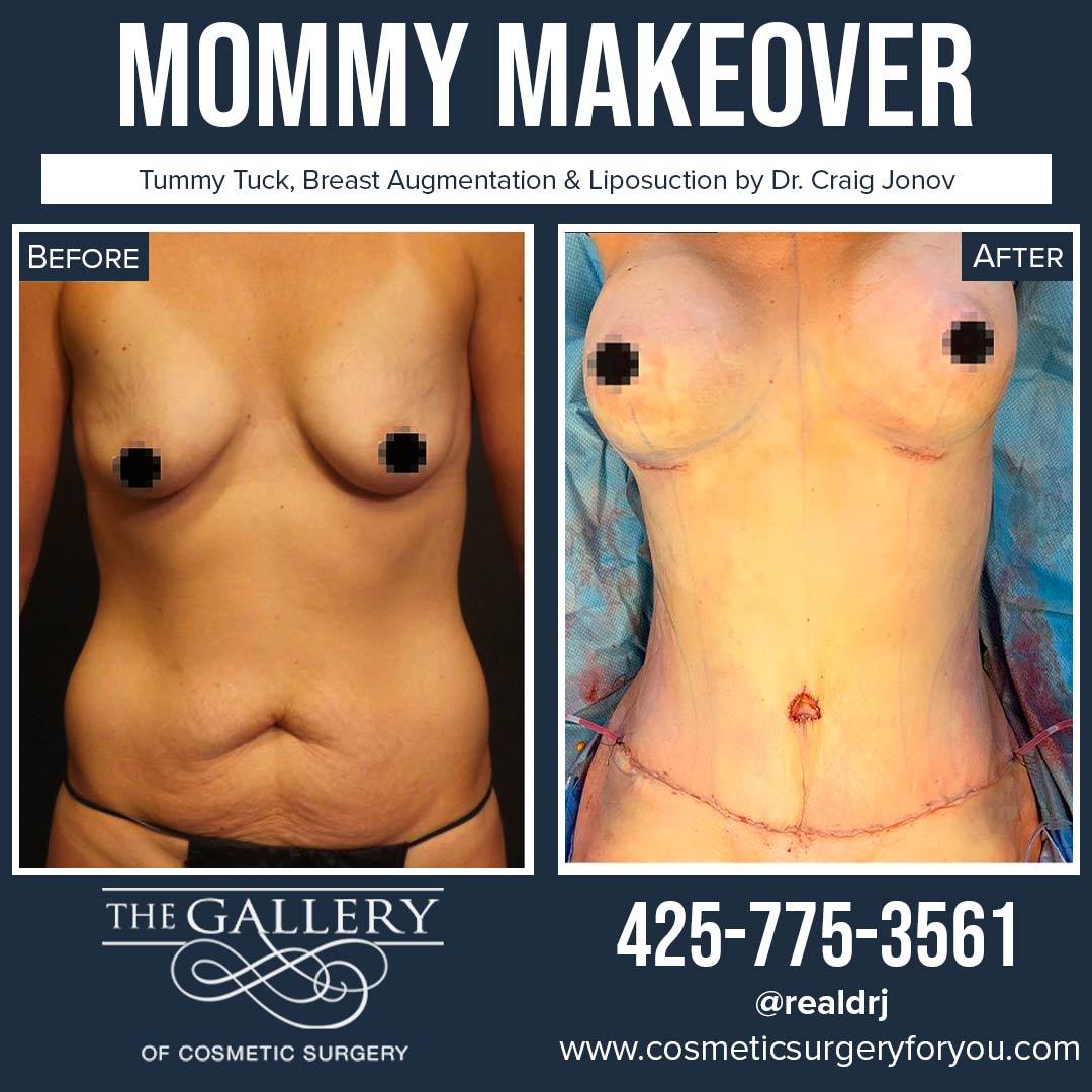 A Before and After photo of a Mommy Makeover Plastic Surgery With Liposuction by Dr. Craig Jonov