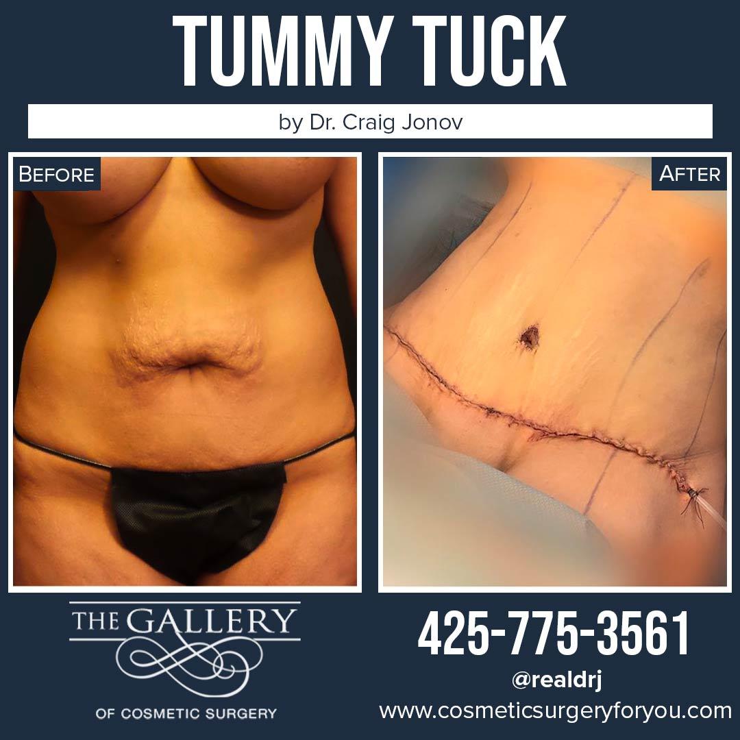 A Before and After photo of a Tummy Tuck Plastic Surgery by Dr. Craig Jonov