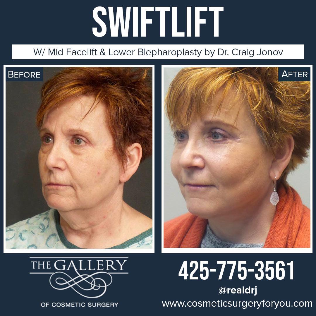 A Before and After photo of a Swiftlift Plastic Surgery by Dr. Craig Jonov