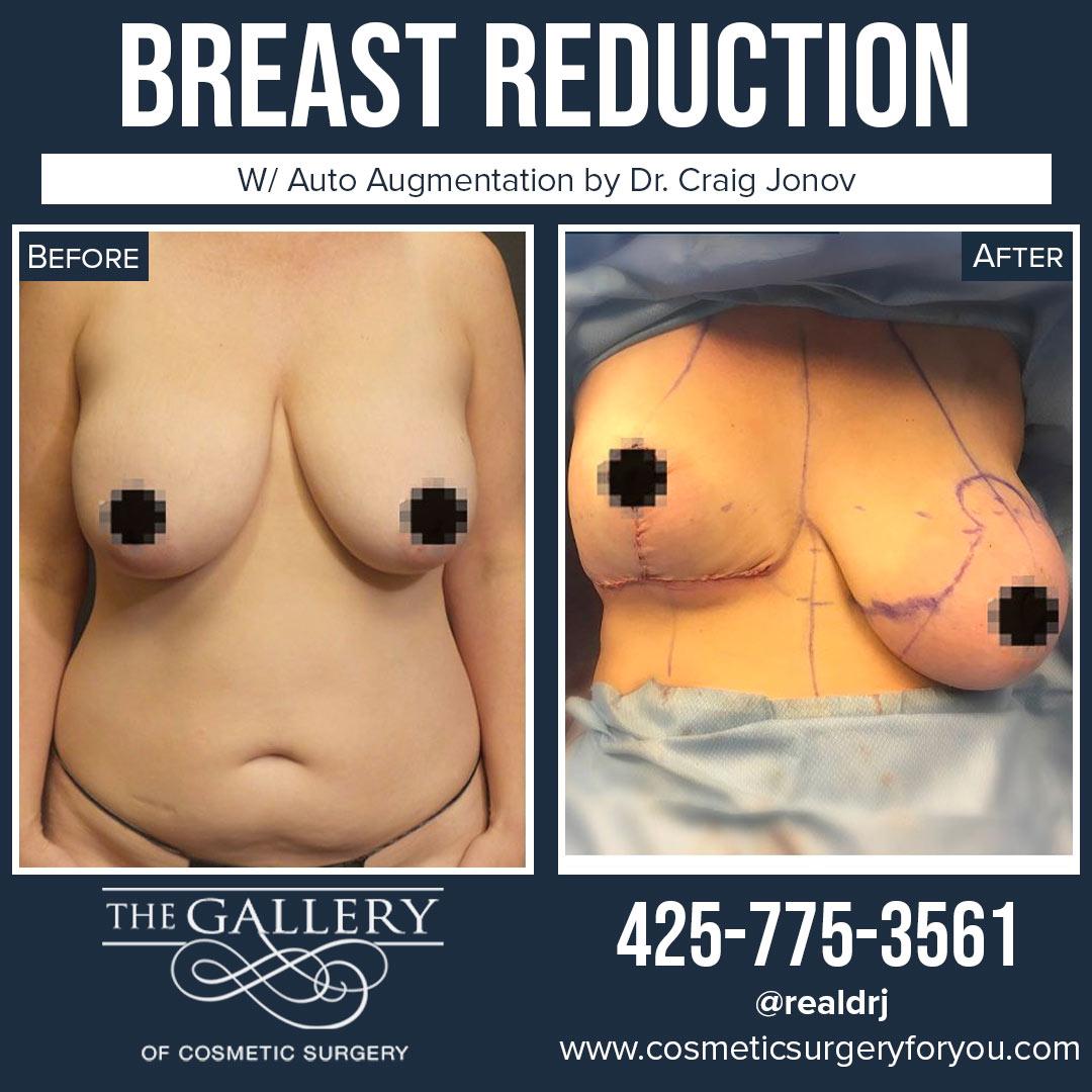 A Before and Intra Op photo of a Breast Reduction Plastic Surgery With Auto Augmentation by Dr. Craig Jonov