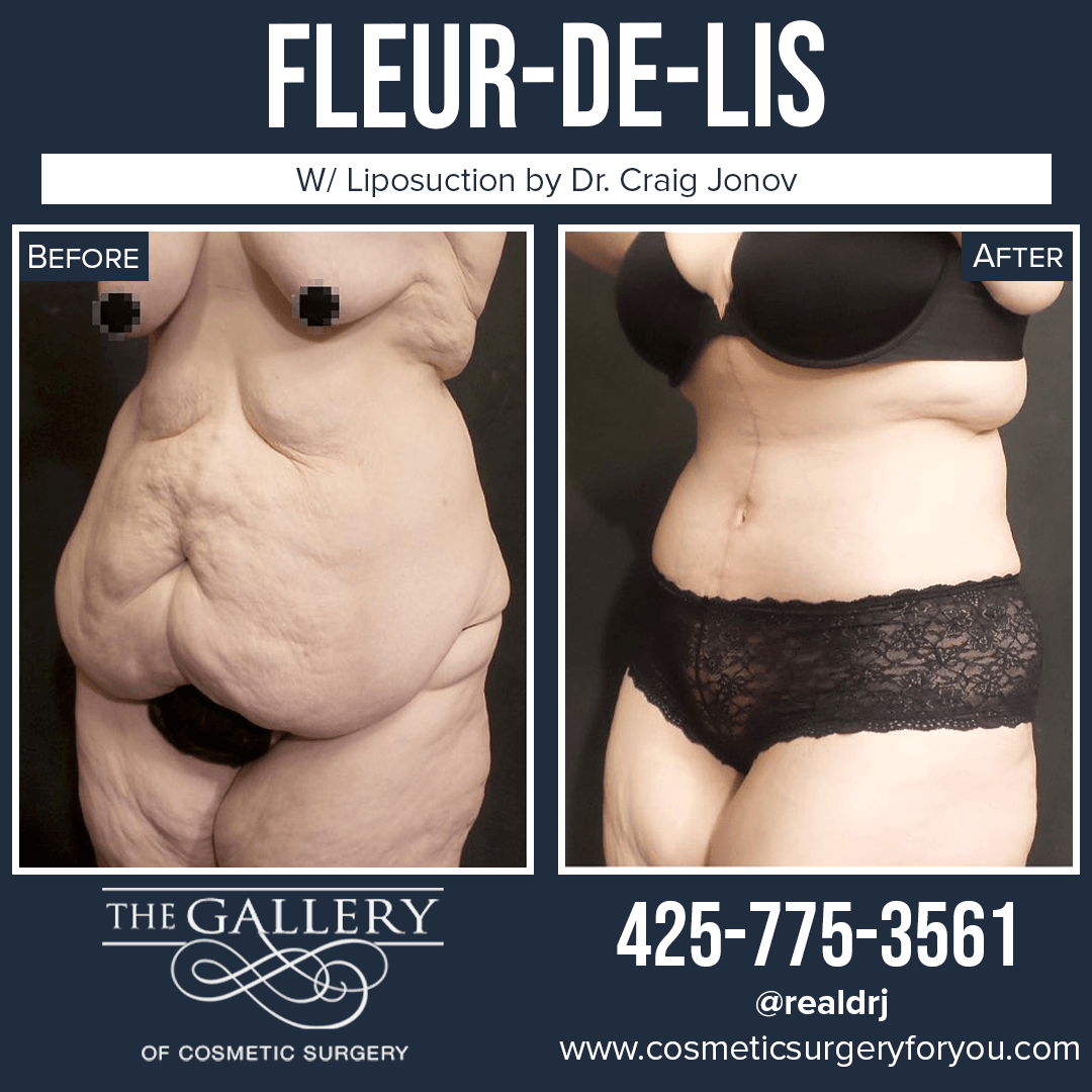 A Before and After Photo of a Fleur-De-Lis Surgery By Dr. Craig Jonov