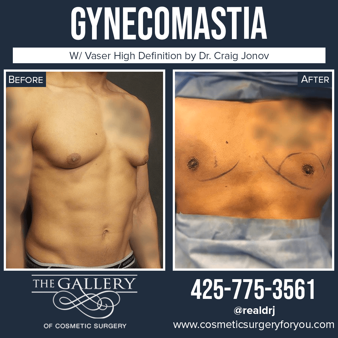 A Before and After Photo of a Surgery for Gynecomastia By Dr. Craig Jonov