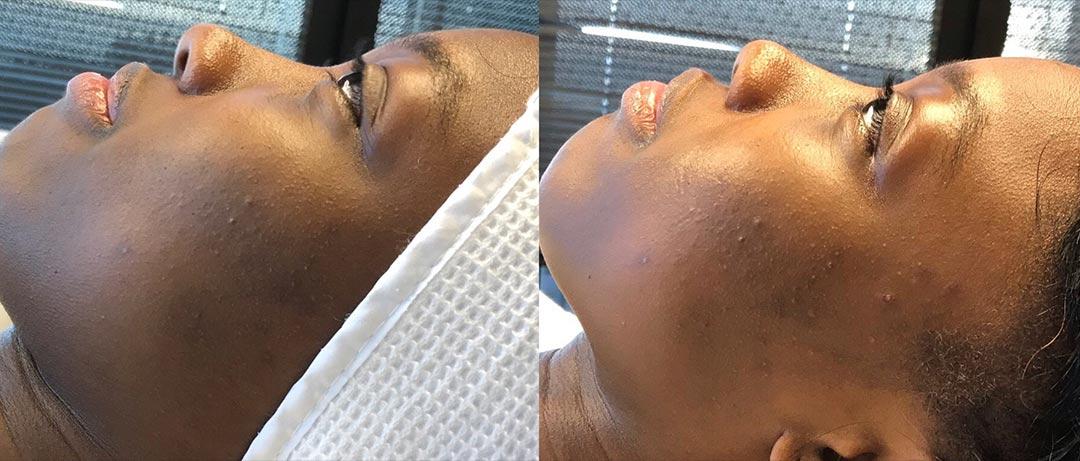 A Before and After Image Of a Patient Who Received a Dermaplaning Procedure At The Gallery of Cosmetic Surgery