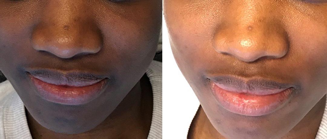 A Before and After Image Of a Patient Who Received a Dermaplaning Procedure At The Gallery of Cosmetic Surgery