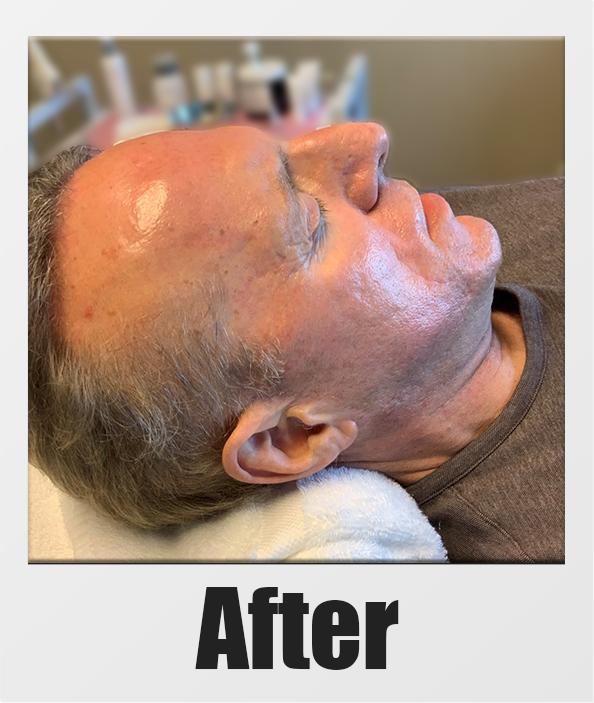 An After Photo of a patient who received a microneedling session in Kirkland Seattle Bellevue