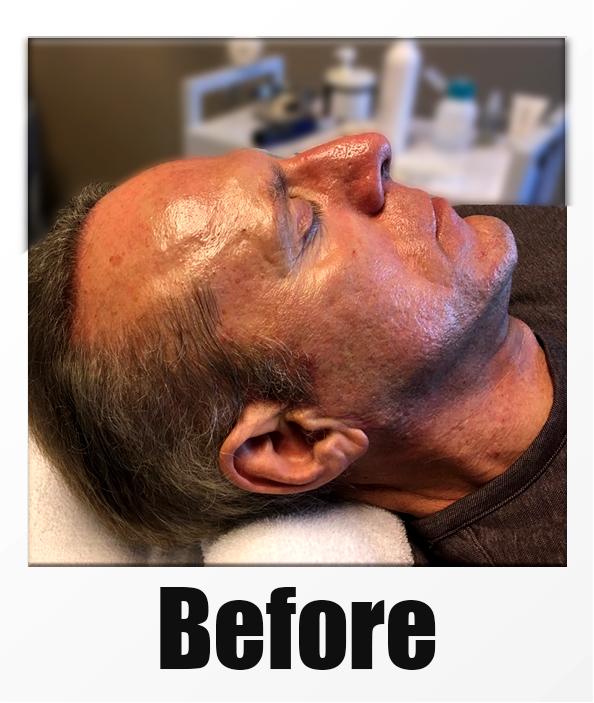 A Before Photo of a patient about to receive a microneedling session in Kirkland Seattle Bellevue