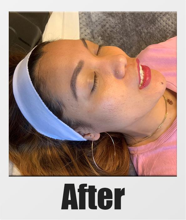 An After Photo of a patient who received a microneedling session in Kirkland Seattle Bellevue