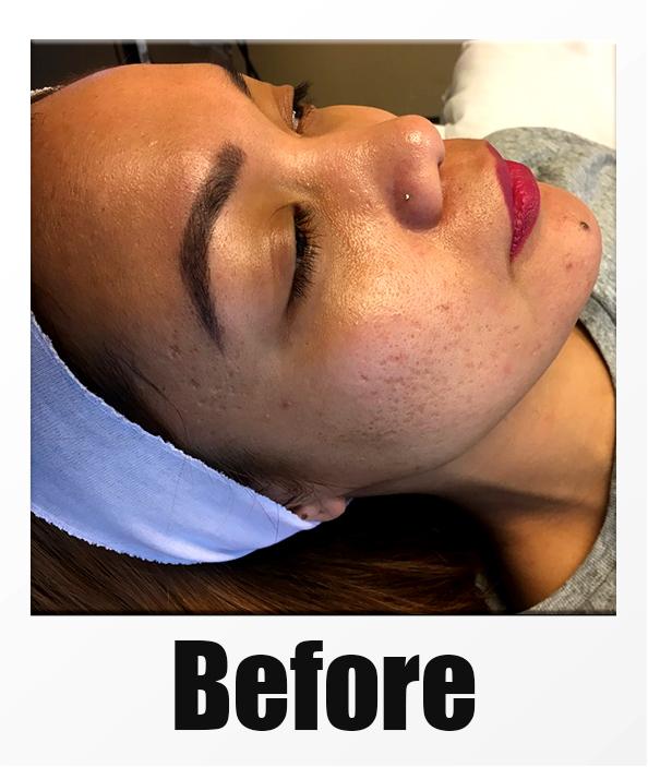 A Before Photo of a patient about to receive a microneedling session in Kirkland Seattle Bellevue