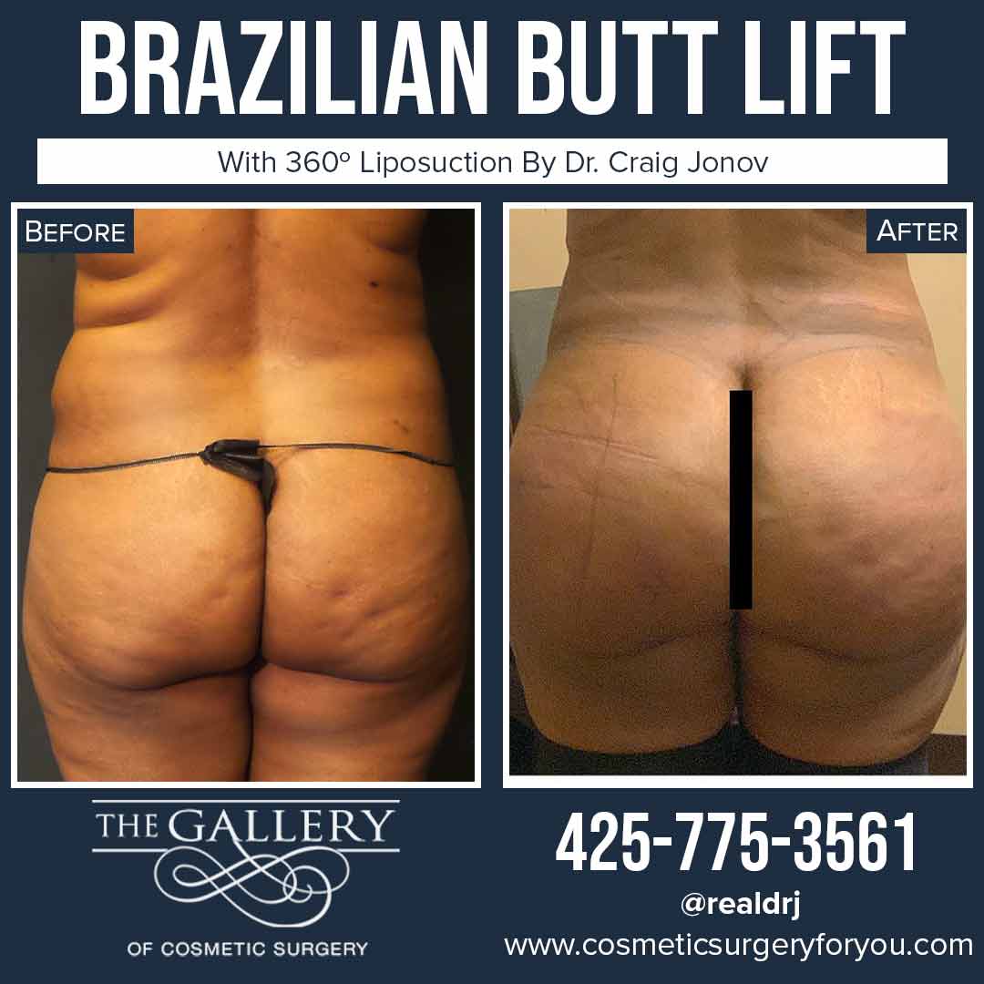 A Before and After photo of a Brazilian Butt Lift Plastic Surgery With Liposuction by Dr. Craig Jonov