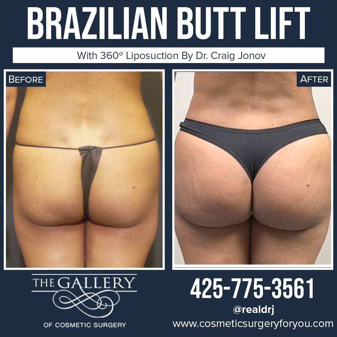 A Before and After photo of a Brazilian Butt Lift Plastic Surgery With Liposuction by Dr. Craig Jonov