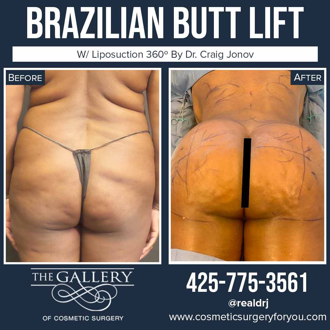 A Before and After photo of a Brazilian Butt Lift Plastic Surgery With Liposuction by Dr. Craig Jonov