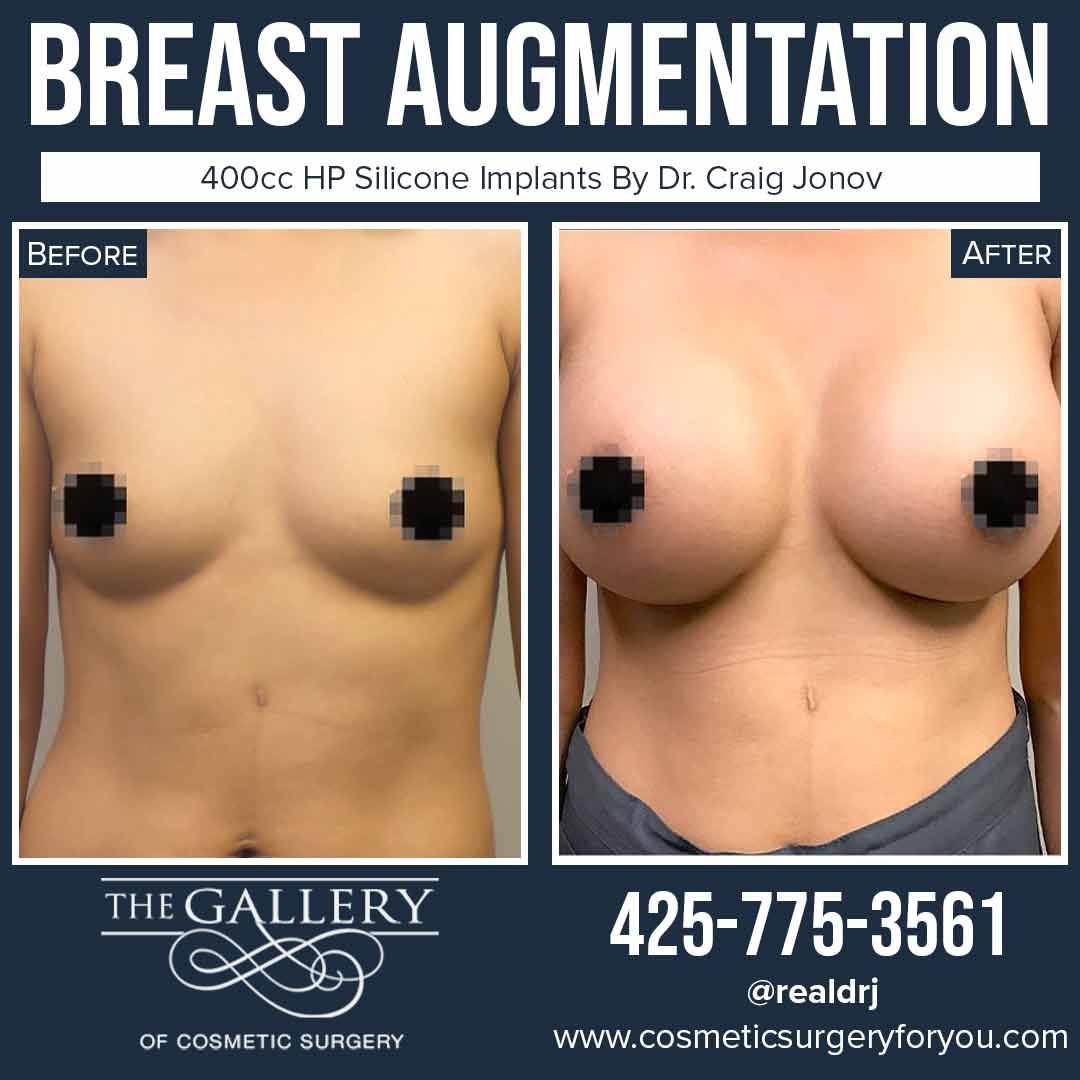 A Before and After photo of a Breast Augmentation Plastic Surgery by Dr. Craig Jonov