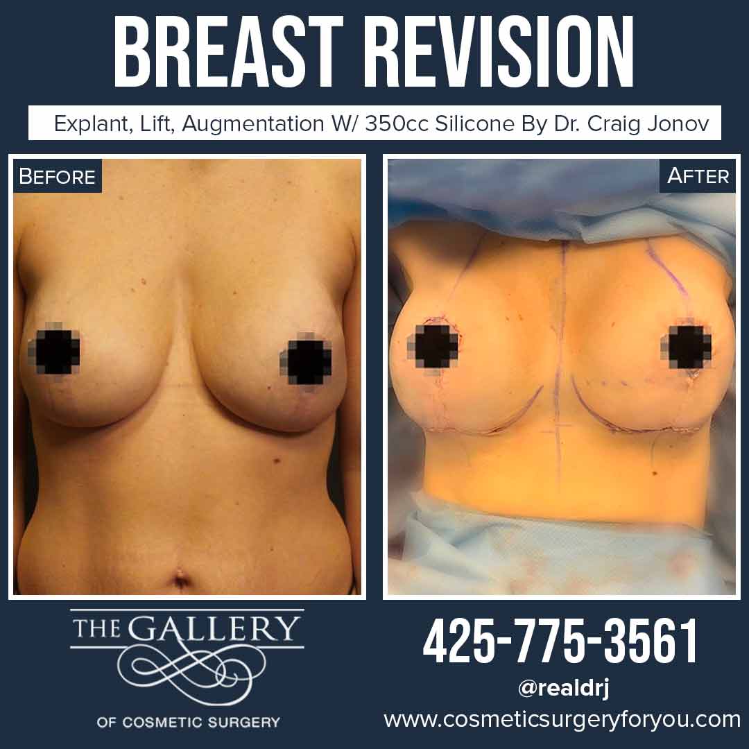 A Before and After photo of a Breast Revision Plastic Surgery by Dr. Craig Jonov