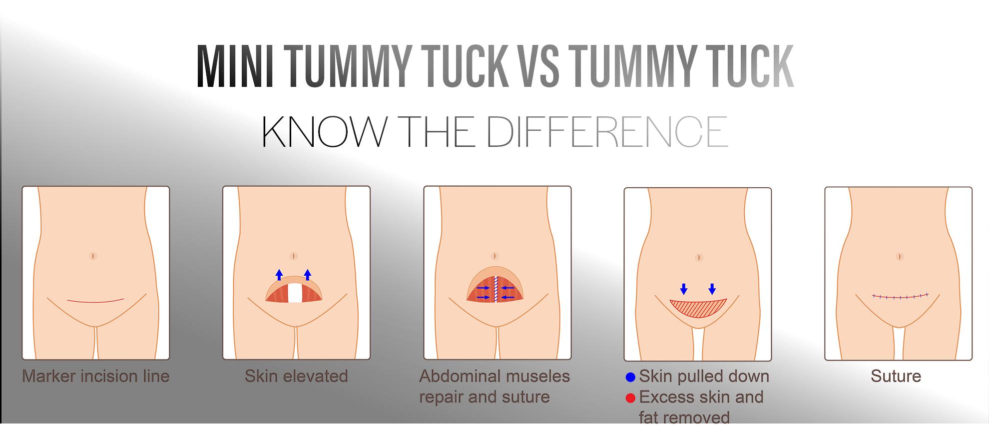 Mini Tummy Tuck vs. Full Tummy Tuck: Choosing the Right Procedure –  Dermatology Associates of Rochester