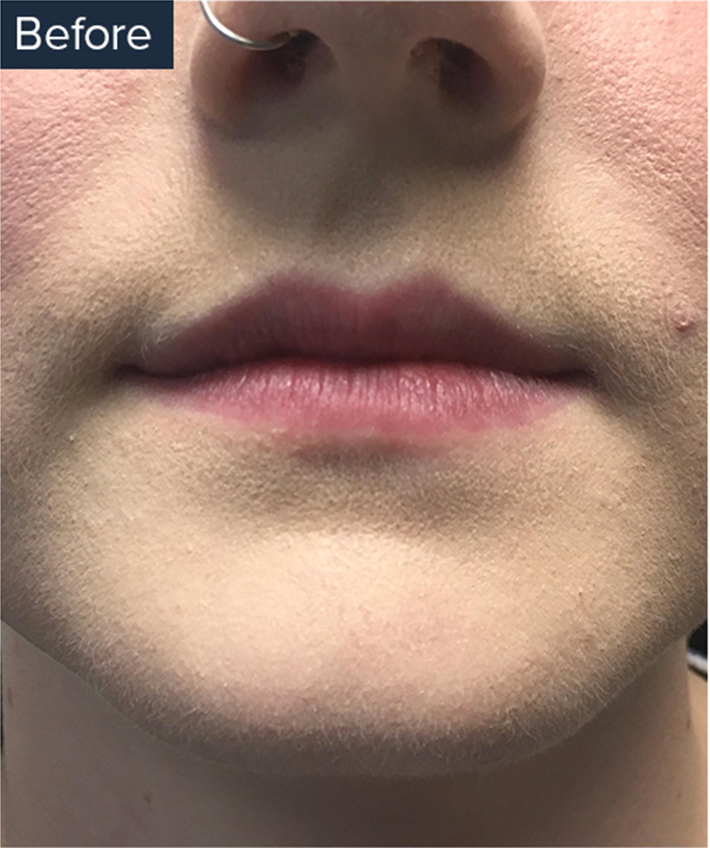 A Before Image Of A Patient Who Received Lip Injections