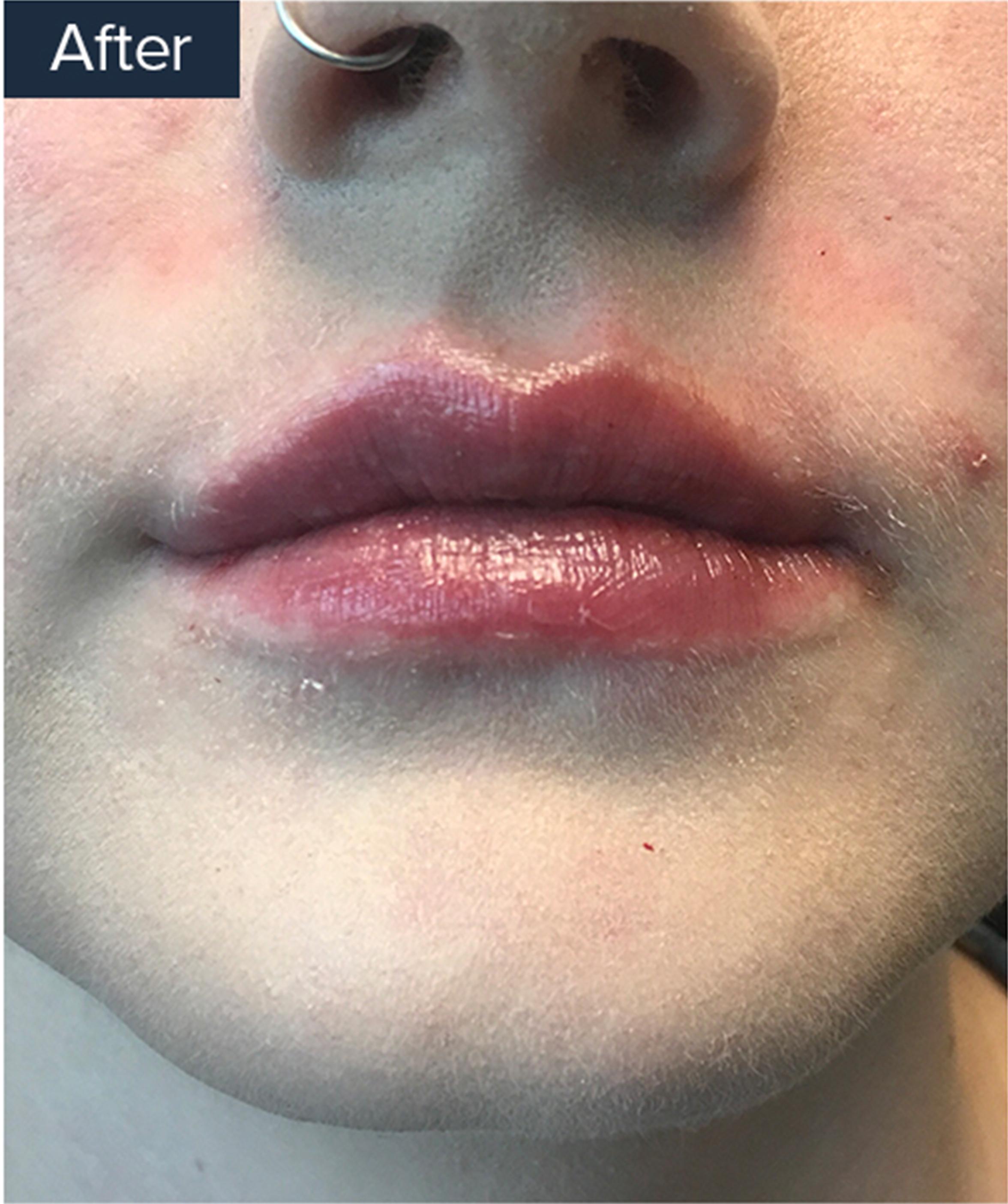 An After Image Of A Patient Who Received lip Injections
