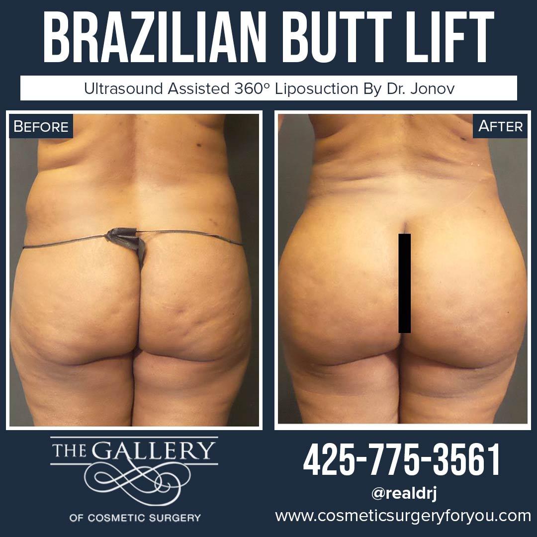 A Before and After photo of a Brazilian Butt Lift Plastic Surgery With Liposuction by Dr. Craig Jonov