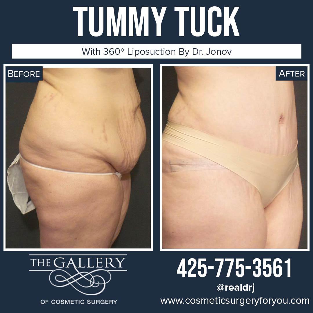 A Before and After photo of a Tummy Tuck Plastic Surgery by Dr. Craig Jonov