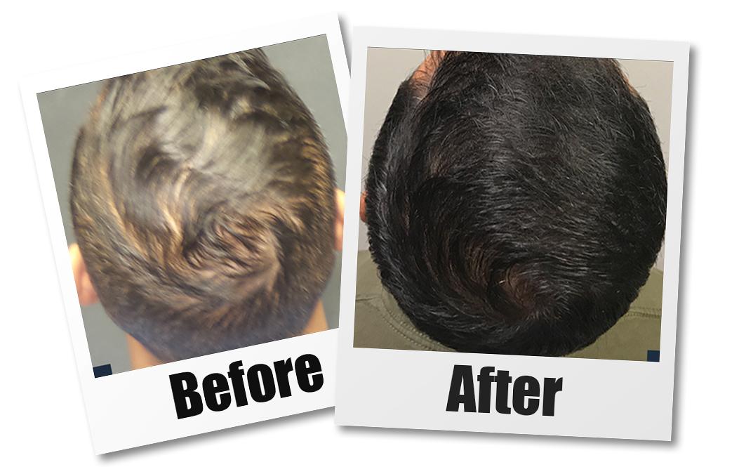 A before and after of a patient who received PRP hair loss treatment