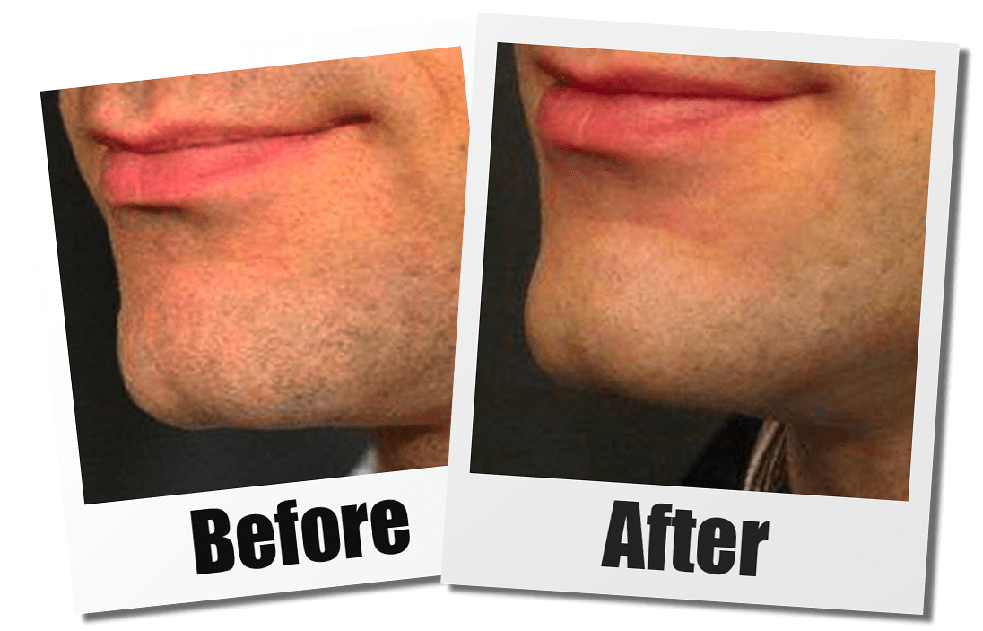 A Before and After Set of Images of A Patient Who Received a Chin Augmentation Plastic Surgery