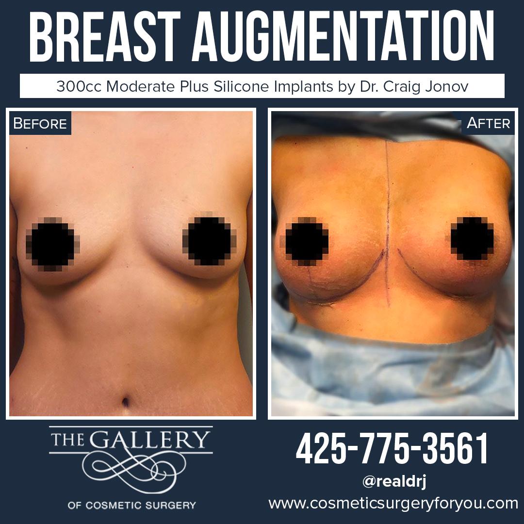 A Before and After photo of a Breast Augmentation Plastic Surgery by Dr. Craig Jonov