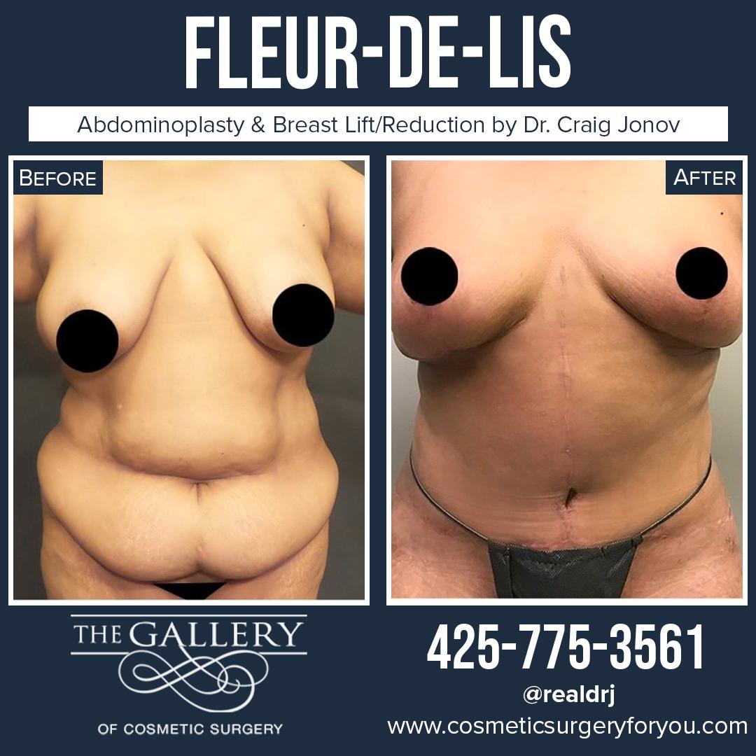 A Before and After Photo of a Fleur-De-Lis Surgery By Dr. Craig Jonov