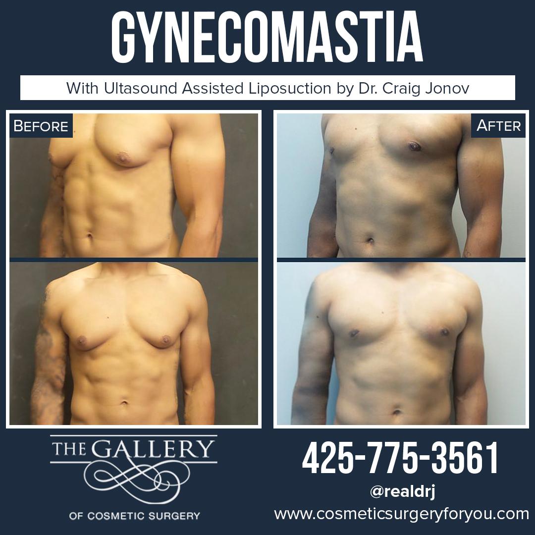 A Before and After Photo of a Surgery for Gynecomastia By Dr. Craig Jonov