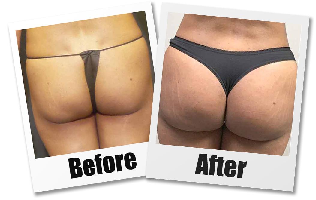 A Before & After set of photos of a patient who received a brazilian butt lift