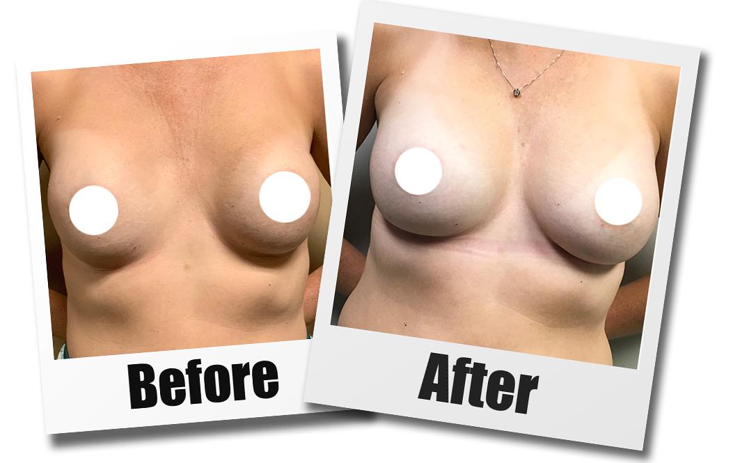 A Before and After Set of Images of A Patient Who Received a Breast Revision Plastic Surgery