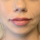 An After photo of lip filler in Seattle, Bellevue, and Kirkland by injector Gyna