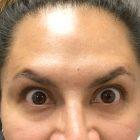 An After photo of BOTOX in Seattle, Bellevue, and Kirkland by injector Lynda