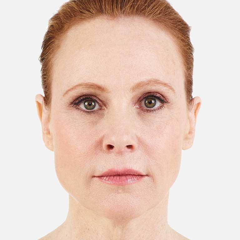An After photo of Juvederm Plastic Surgery by Dr. Craig Jonov