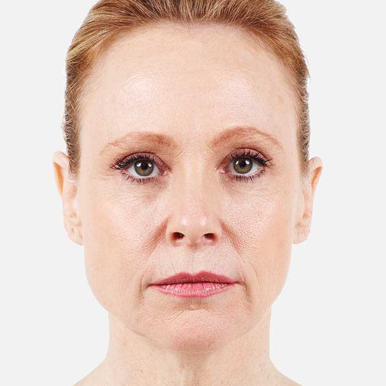 beforejuvederm
