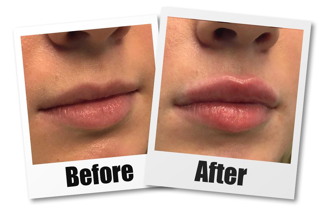 lipfillersba