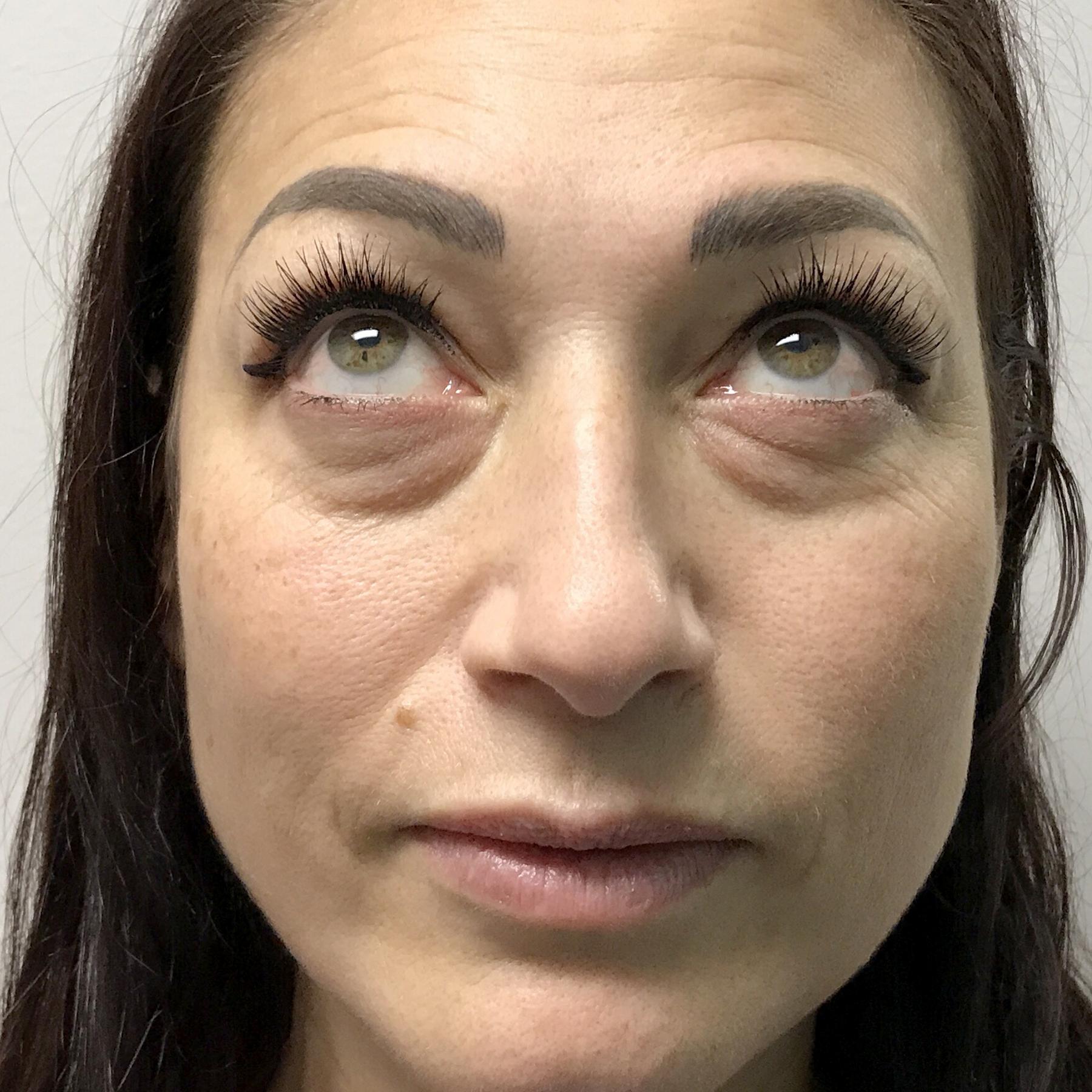 A Before photo of Tear Trough Filler Injections in Seattle, Bellevue, and Kirkland