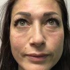 An After photo of Tear Trough Filler in Seattle, Bellevue, and Kirkland