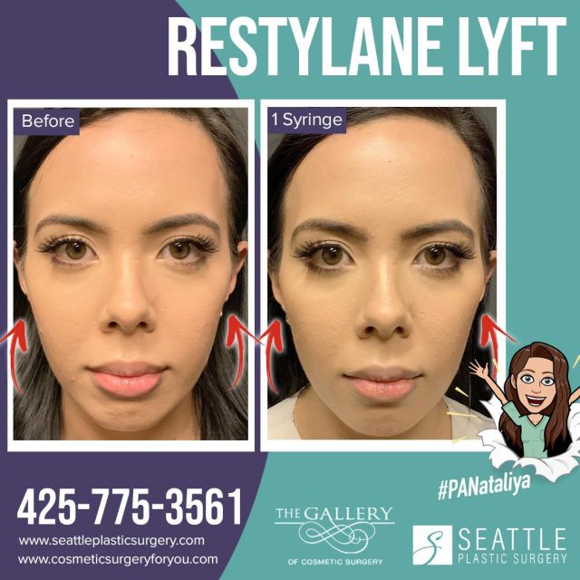 Instagram Before and After photo of cheek filler by PA Nataliya in Seattle, Bellevue, and Kirkland