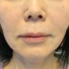 An After photo of Nasolabial Fold Filler by Injector Nataliya in Seattle, Bellevue, and Kirkland