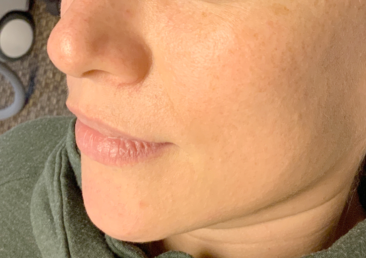 An After photo of the Glow Up Package by Master Esthetician Kyla in Seattle, Bellevue, and Kirkland