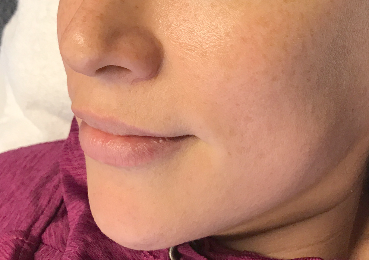 A Before photo of the Glow Up Package by Master Esthetician Kyla in Seattle, Bellevue, and Kirkland